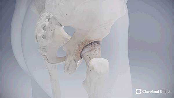 Animation of hip resurfacing surgery