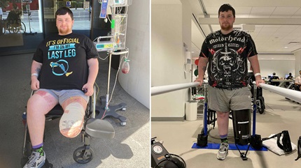 Jordan Collins, motorcycle crash survivor walks again after amputation.