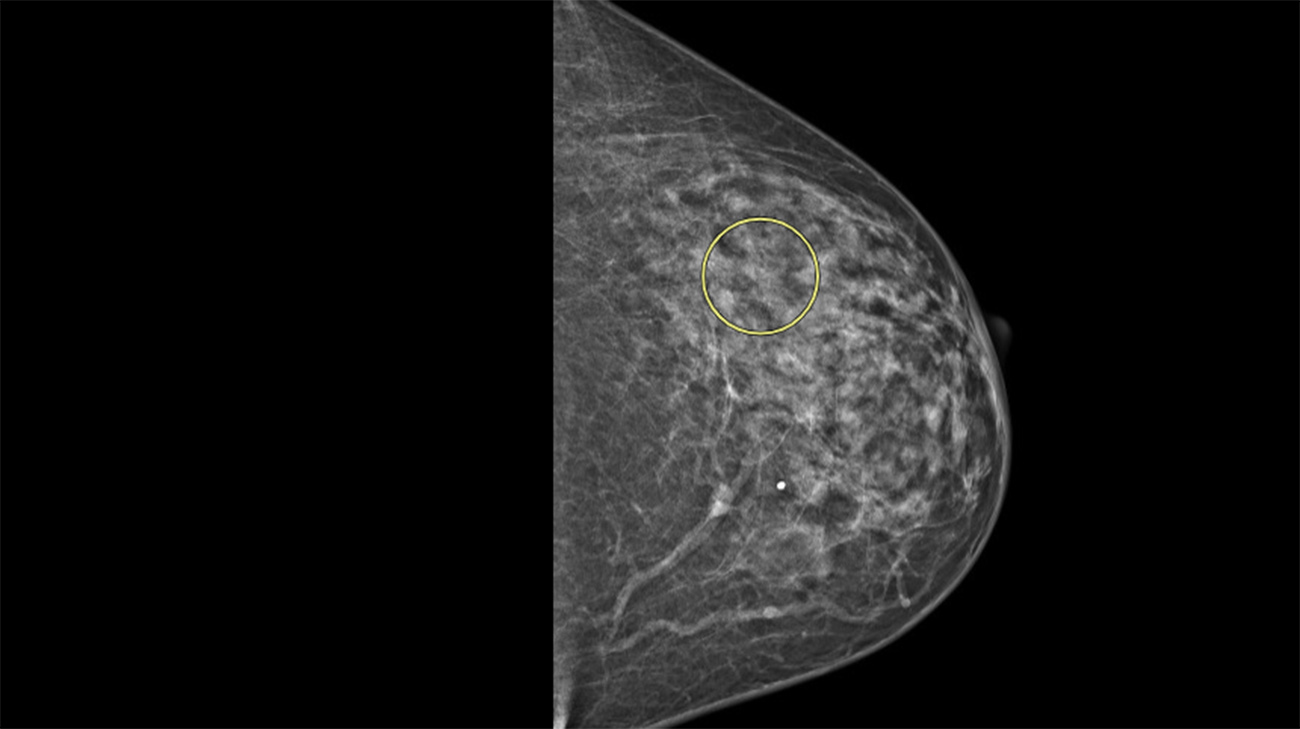 Mammogram of lobular breast cancer. 